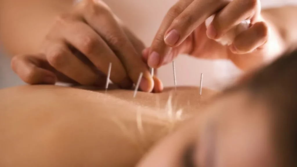 Mulher recebendo agulhas de acupuntura nas costas