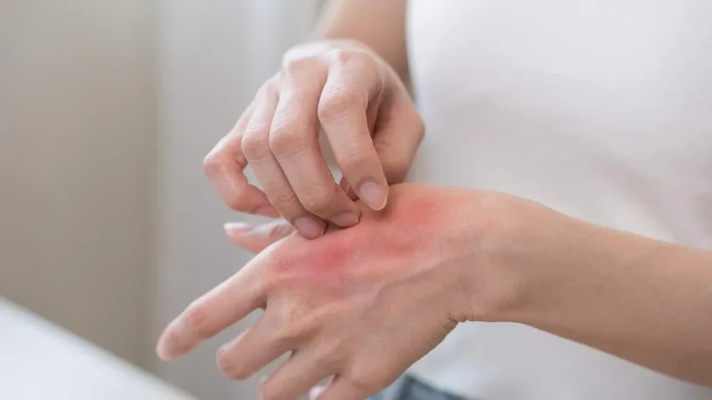 Imagem Dermatite do artigo Você sabia? Sua alimentação pode melhorar a dermatite