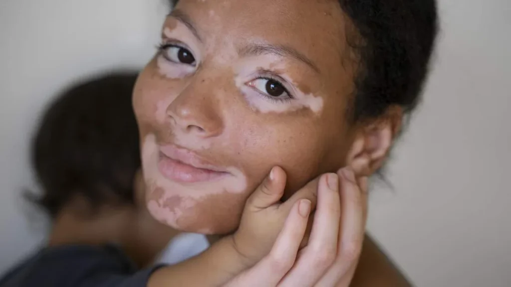 Imagem Mulher com vitiligo do artigo Vitiligo: acolhimento, informação e respeito